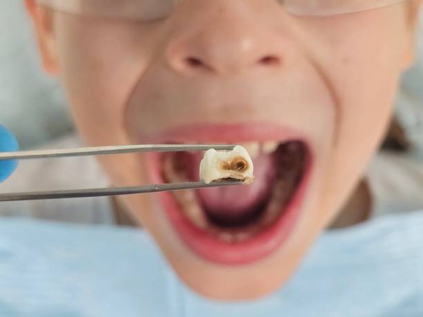 Best Emergency Wisdom Teeth Removal in Sparta, IL